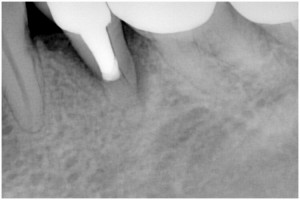 河合２　根破折